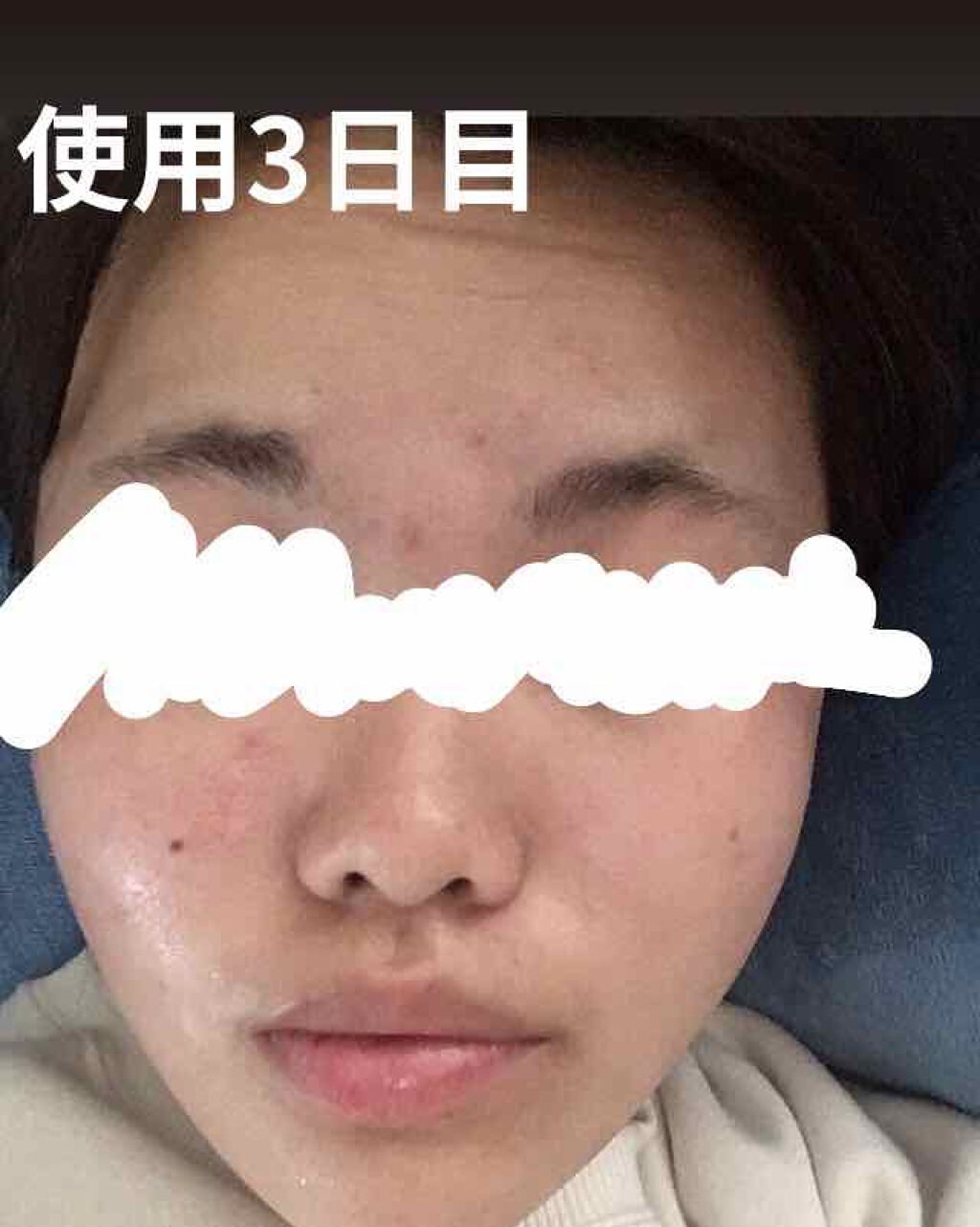 テラ コートリル 軟膏 医薬品 ジョンソン エンド ジョンソンを使った口コミ みなさんこんにちはっ 今日はスキンケ By お魚クッキー 普通肌 代前半 Lips