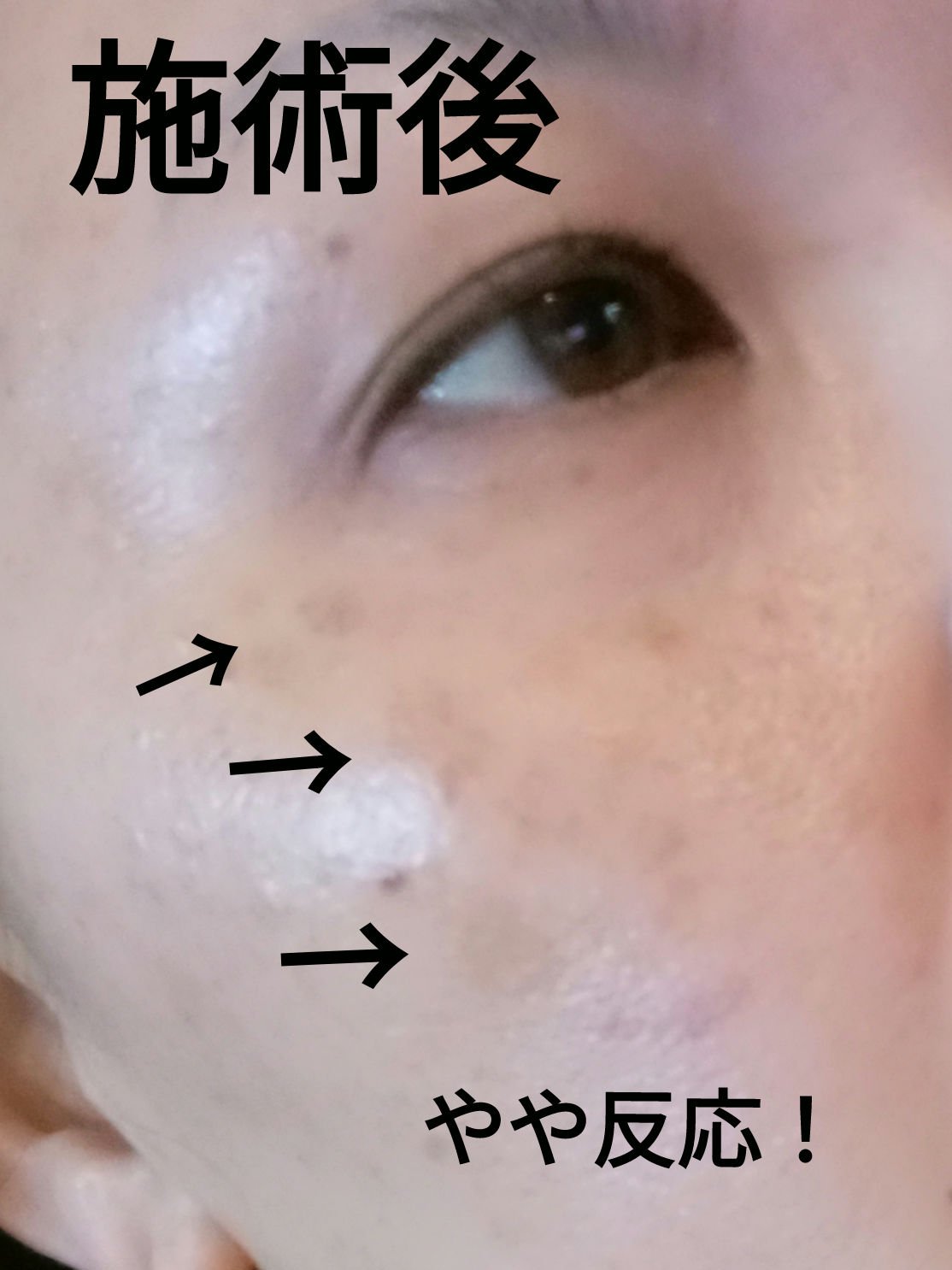 フォトダブル/湘南美容クリニック/その他を使ったクチコミ（3枚目）