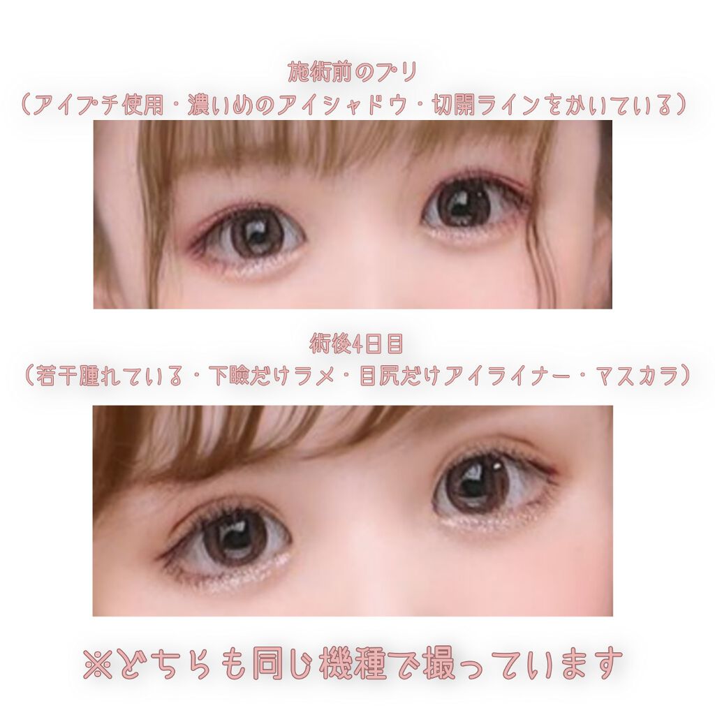 二重整形/その他を使ったクチコミ（3枚目）