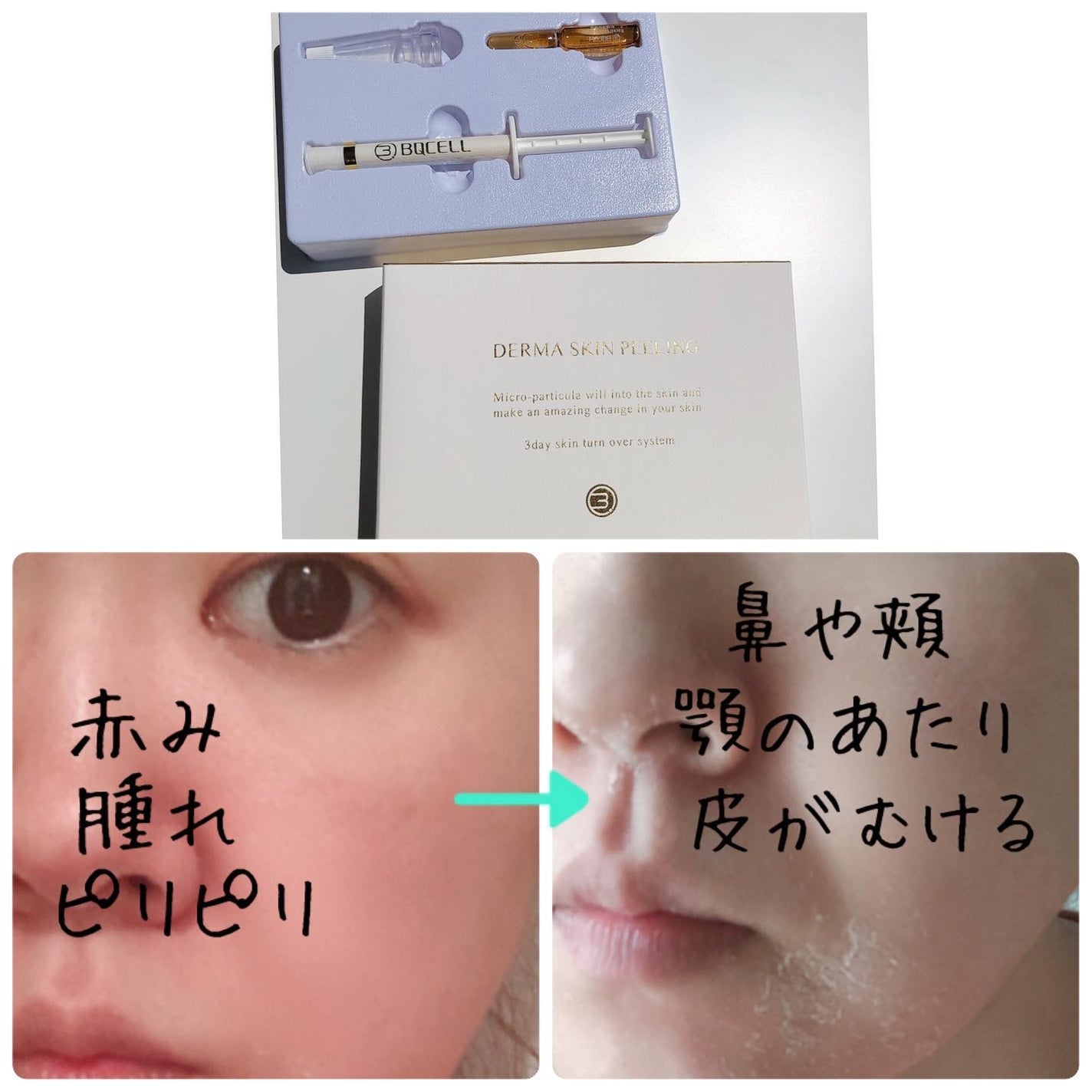 ダーマスキンピーリング/BQCELL/その他キットセットを使ったクチコミ(4枚目)