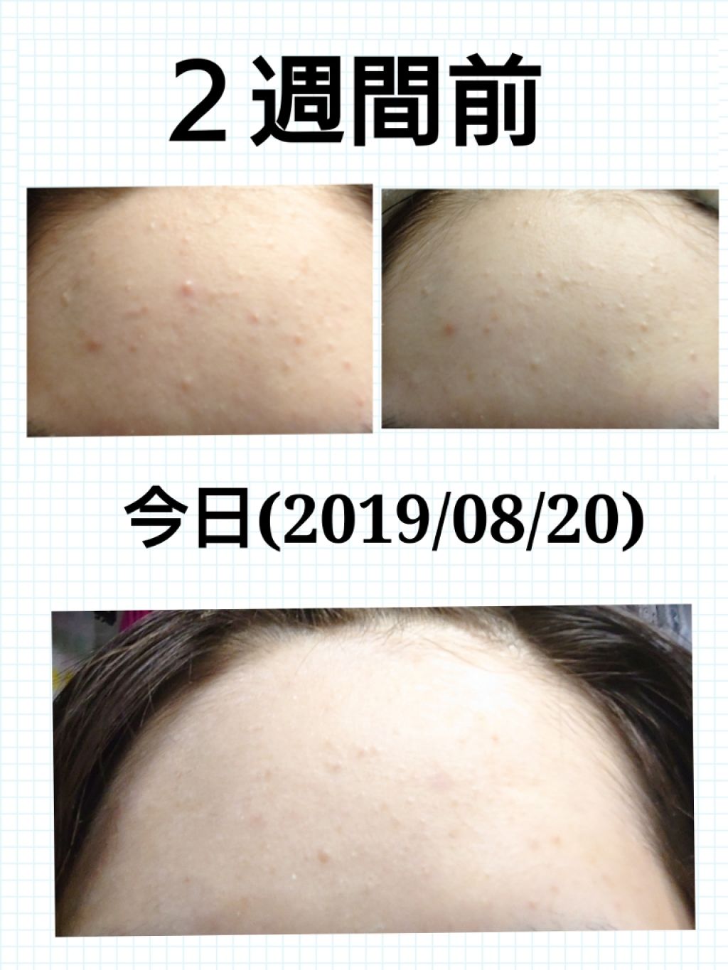 ロゼット洗顔パスタ アクネクリア/ロゼット/洗顔フォームを使ったクチコミ（2枚目）