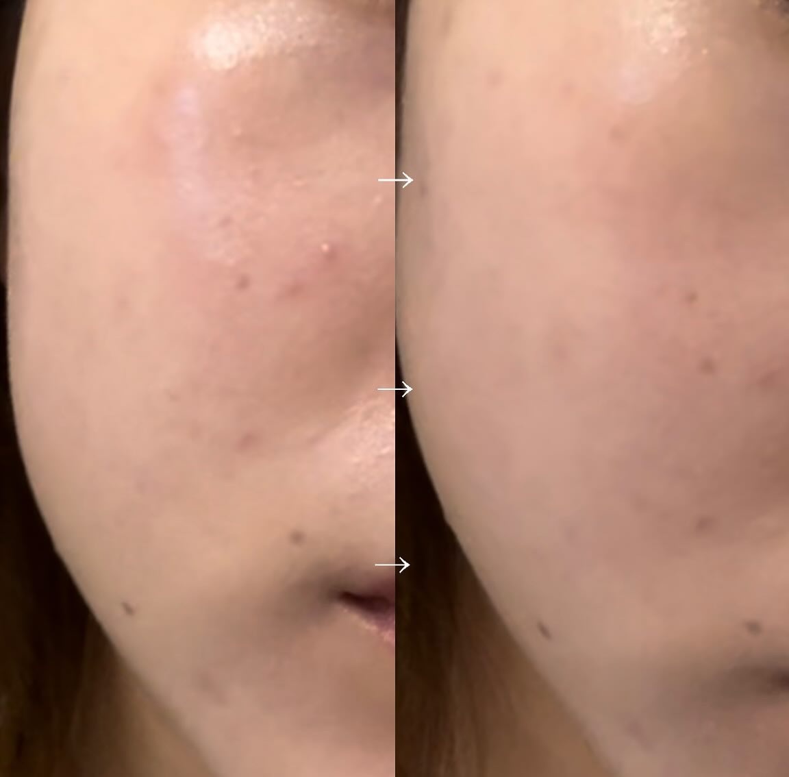 【旧品】マシュマロフィニッシュパウダー/キャンメイク/プレストパウダーを使ったクチコミ（3枚目）