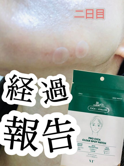 プロCICA クリアスポットパッチ/VT/その他スキンケアを使ったクチコミ(1枚目)