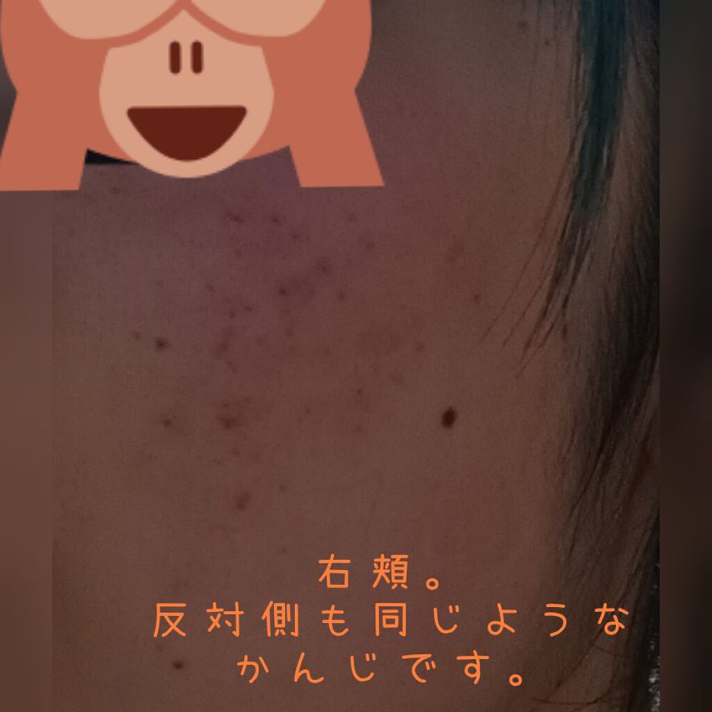 A アクネフォーム/NOV/洗顔フォームを使ったクチコミ（2枚目）