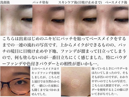ゼロスポットパッチ/Today’s Cosme/にきびパッチを使ったクチコミ(4枚目)