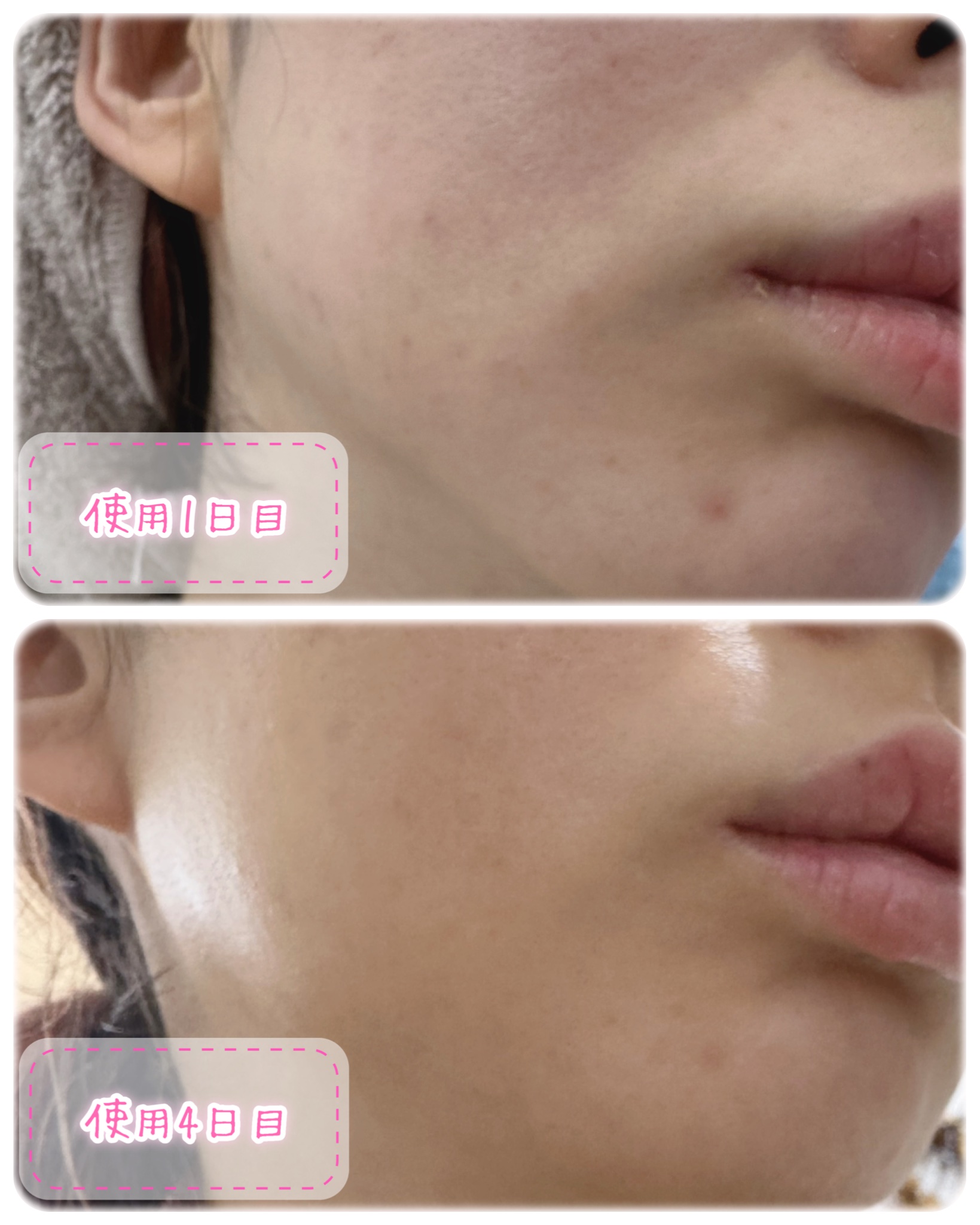 CHOI薬用マスク ニキビケア ［医薬部外品］/肌美精/シートマスク・パックを使ったクチコミ（3枚目）