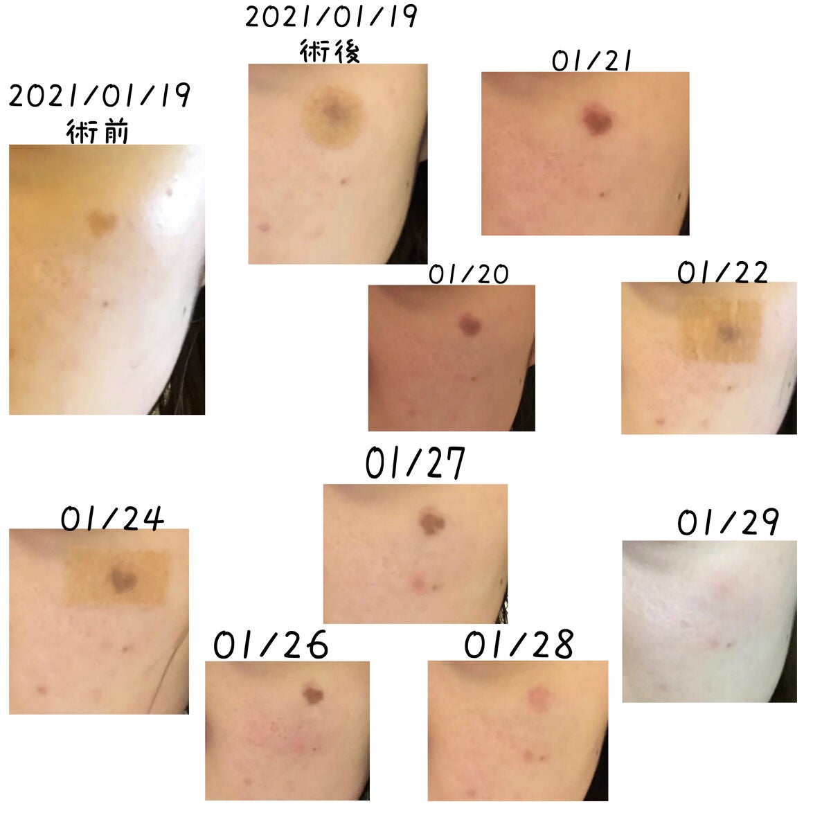 おんたま(フォロバ100) on LIPS 「2年前にシミ取りをしたので経過を載せます📸✂ーーーーーーーーー..」(2枚目)