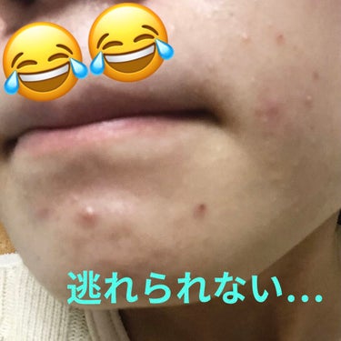 やっぺい on LIPS 「汚肌注意これはまだ何も結果がありません。ただの報告です。申し訳..」（1枚目）