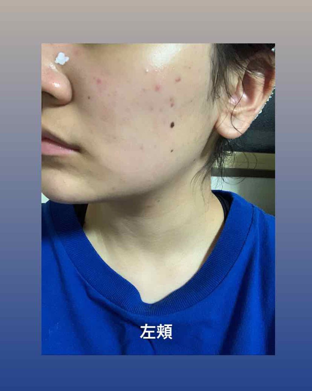 S.O.S スポットパウダー/VELY VELY/その他スキンケアを使ったクチコミ（1枚目）