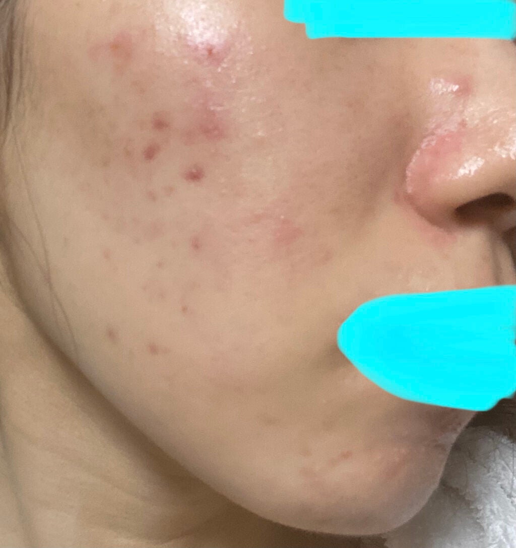 「大人になったらニキビ治るよ」はウソです on LIPS 「自分用の記録です。万年ニキビ面の24歳女がニキビを治すためにが..」(3枚目)