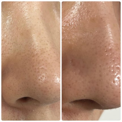 ディープクリーンマスター/ilso/その他スキンケアグッズを使ったクチコミ(7枚目)