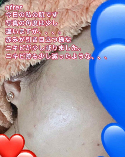 ティーツリーケア ソリューション エッセンシャルマスクEX/MEDIHEAL/シートマスク・パックを使ったクチコミ(4枚目)