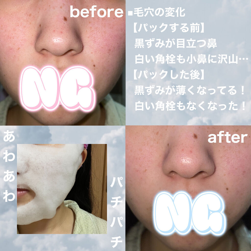 炭酸バブルパック（洗い流すタイプ）/イエスパ/洗い流すパック・マスクを使ったクチコミ（2枚目）