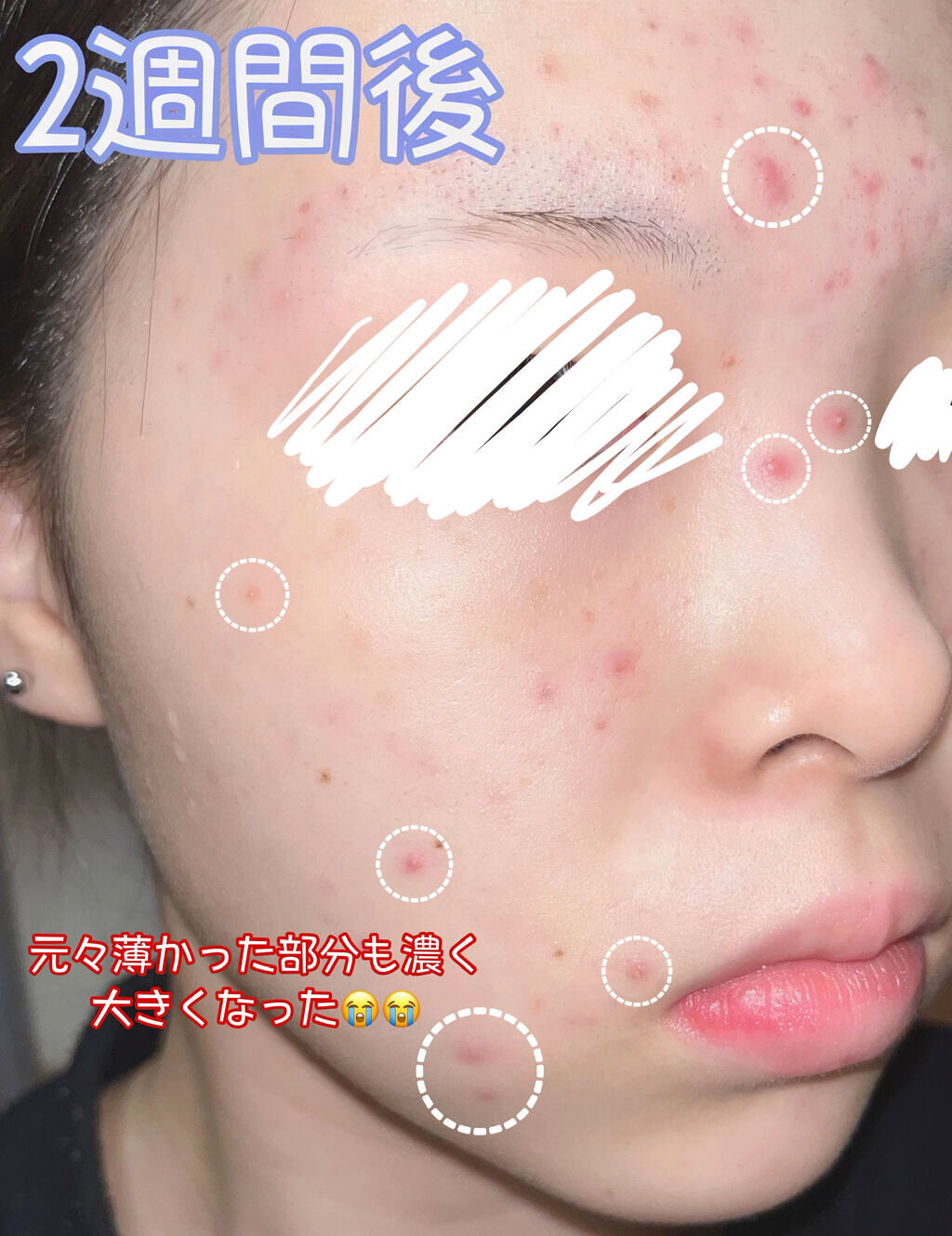 オードムーゲ 薬用ローション（ふきとり化粧水）/オードムーゲ/拭き取り化粧水を使ったクチコミ（3枚目）