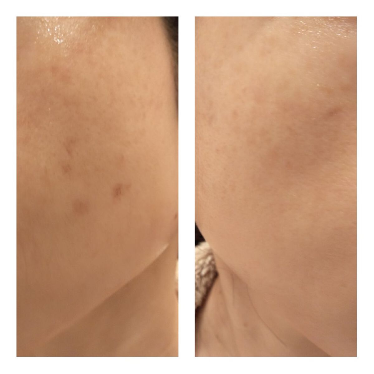 あにゃにゃ♡フォロバ100♡ on LIPS 「11/12に4回目のフォトシルクプラス(シミ取り)を受けてきま..」(6枚目)