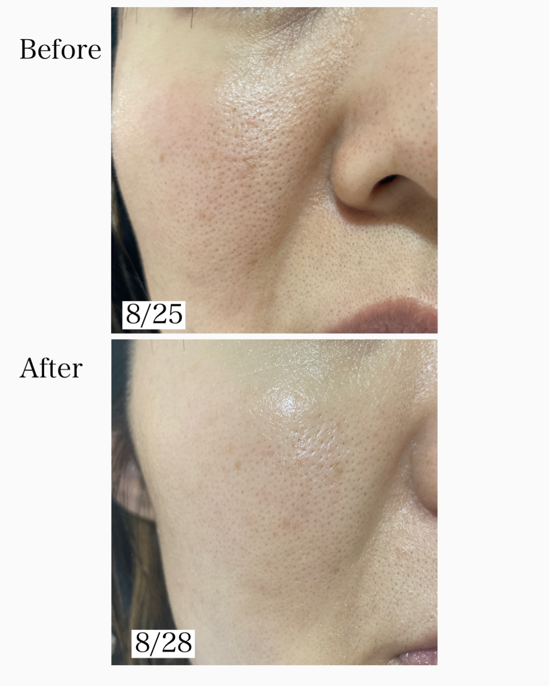 リードルショット300/VT/美容液を使ったクチコミ（3枚目）