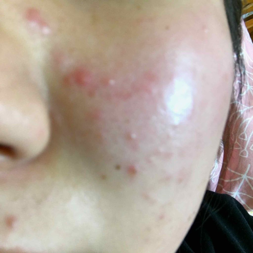 coral_gloss_bvw on LIPS 「このようなニキビってどうしたら治りますか🥵ずっと悩んでいて、、..」(1枚目)