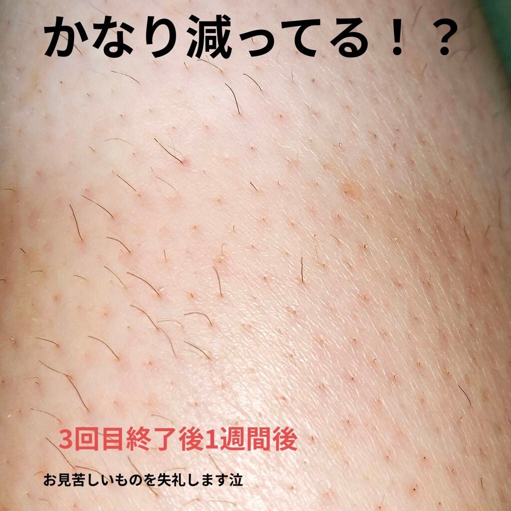 ブラウンシルクエキスパート (光美容器)/ブラウン/家庭用脱毛器を使ったクチコミ(2枚目)