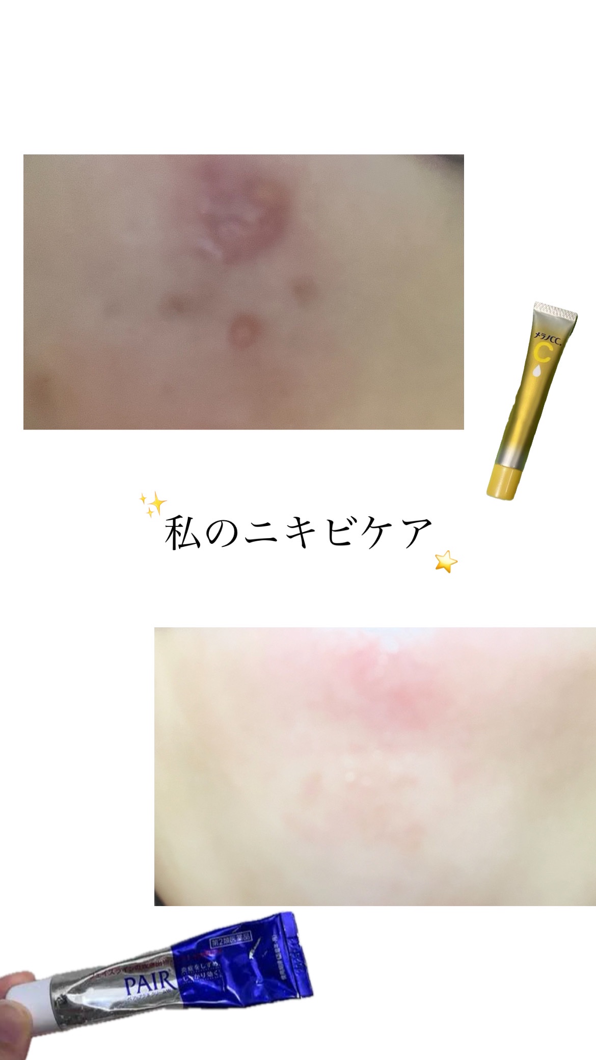 ペアアクネクリームW(医薬品)/ペア/その他を使ったクチコミ（1枚目）