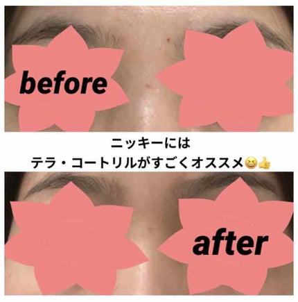 テラ・コートリル 軟膏(医薬品)/ジョンソン・エンド・ジョンソン/その他を使ったクチコミ(1枚目)