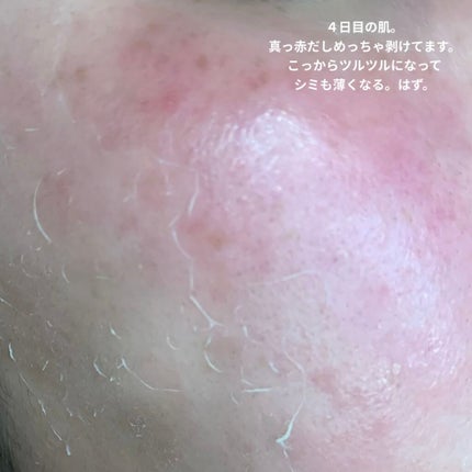 EUKROMA ハイドロキノンクリーム4% 20g/EUKROMA/その他スキンケアを使ったクチコミ(5枚目)