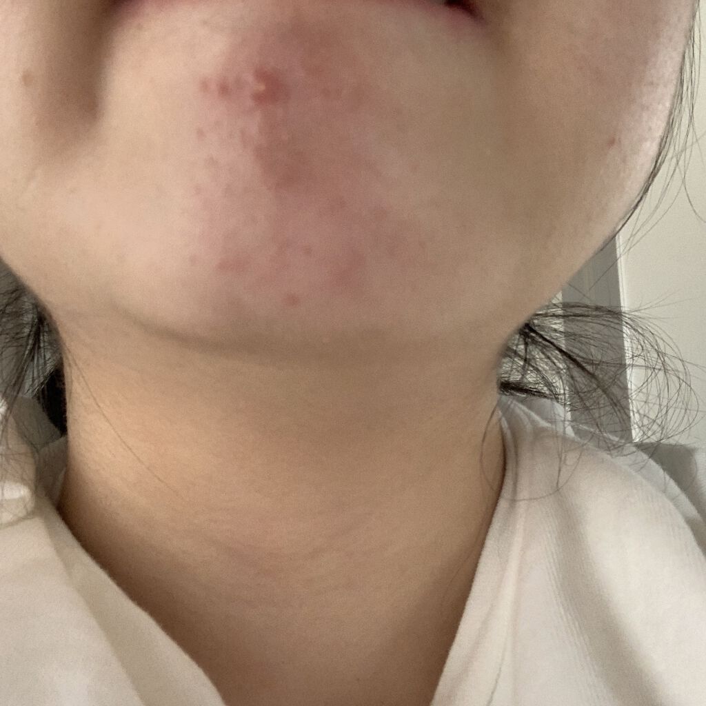 ノブ Ａ アクネソープ/NOV/洗顔石鹸を使ったクチコミ（3枚目）