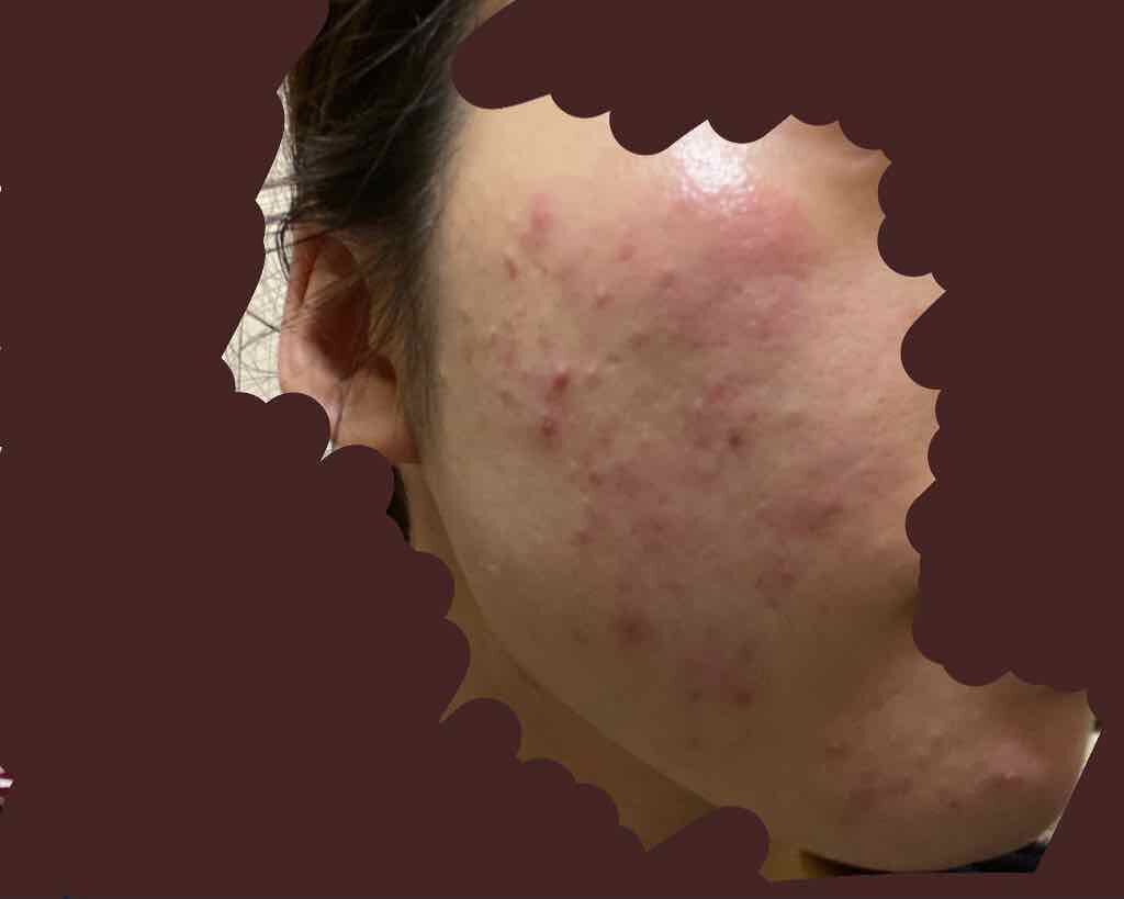 エピデュオゲル/マルホ株式会社/その他を使ったクチコミ（2枚目）