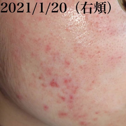 楓@LIPSパートナー on LIPS 「#ニキビスキンケア初投稿です。いきなり黒歴史を公開いたします笑..」(4枚目)