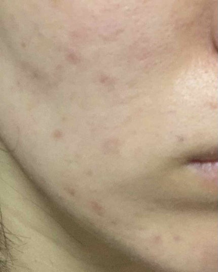 オレンジ on LIPS 「【ニキビ記録290日目】ホルモンバランスみだれ中😨ほとんど毎日..」(1枚目)