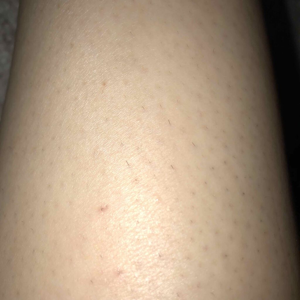 アイスレディ/icelady/家庭用脱毛器を使ったクチコミ（2枚目）