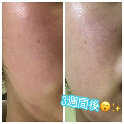 敏感肌用薬用美白美容液/無印良品/美容液を使ったクチコミ(1枚目)