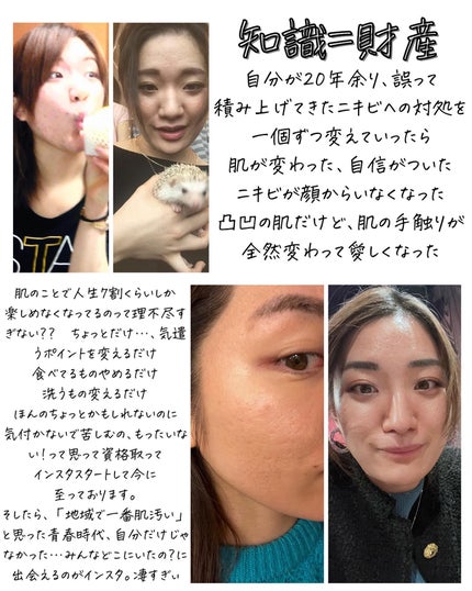 おゆみ|ニキビ・ニキビ跡ケア on LIPS 「【みんなどうやって治したの?ニキビ!しくじり先生part3】ニ..」(6枚目)