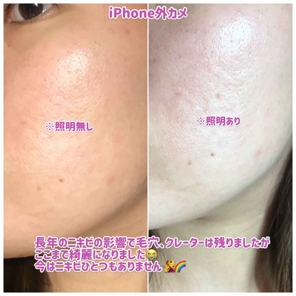 ジア:)脂性肌 on LIPS 「🚨ニキビ写真あります🚨(恥ずかしいですが、⚠️万年ニキビ肌⚠️..」(4枚目)