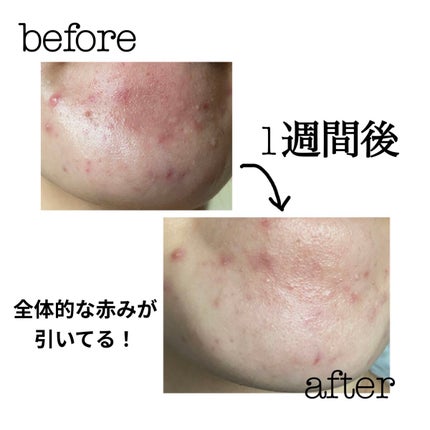 AHA·BHA·PHA 30デイズミラクルトナー/SOME BY MI/化粧水を使ったクチコミ(2枚目)