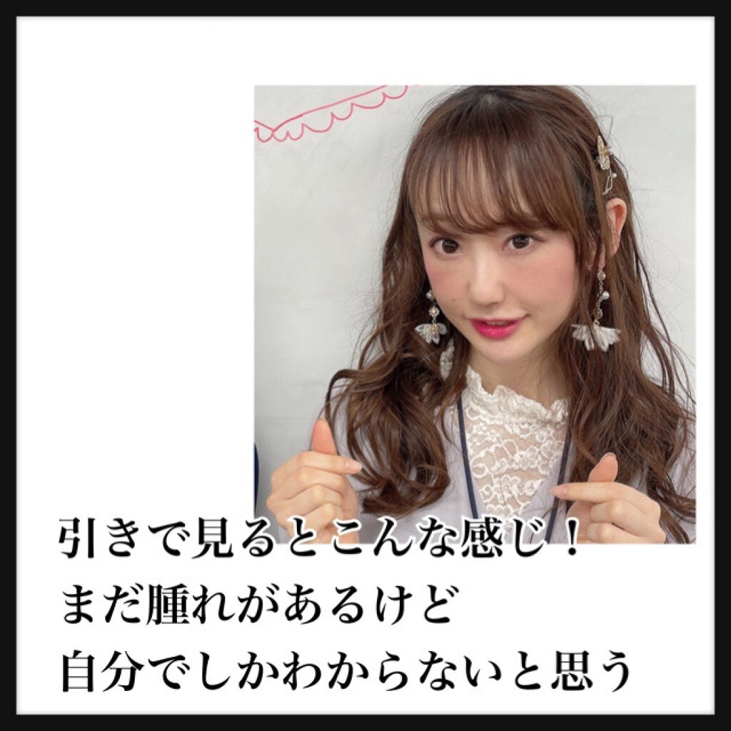 【旧】ディオールスキン フォーエヴァー スキン コレクト コンシーラー/Dior/リキッドコンシーラーを使ったクチコミ(5枚目)