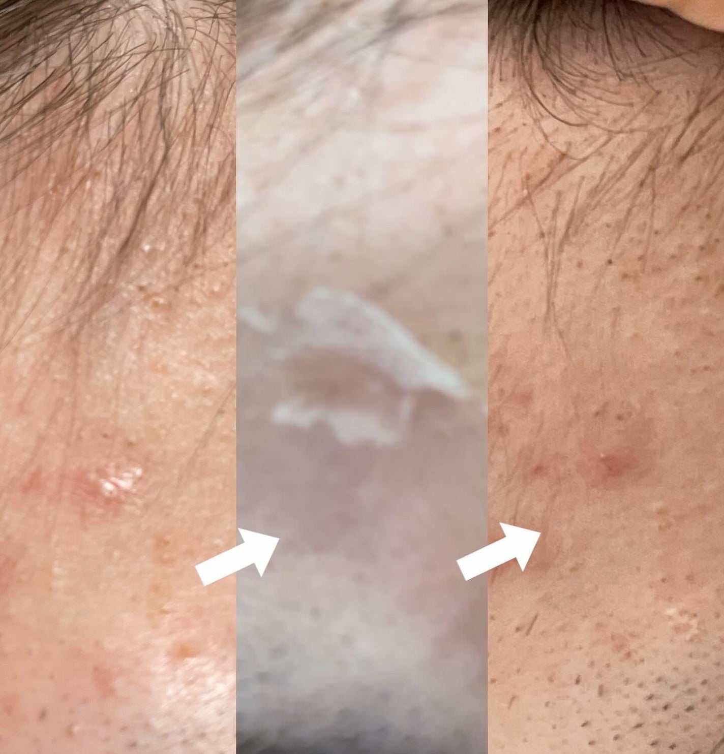 CICA method RECOVER PATCH/コジット/その他スキンケアを使ったクチコミ(4枚目)