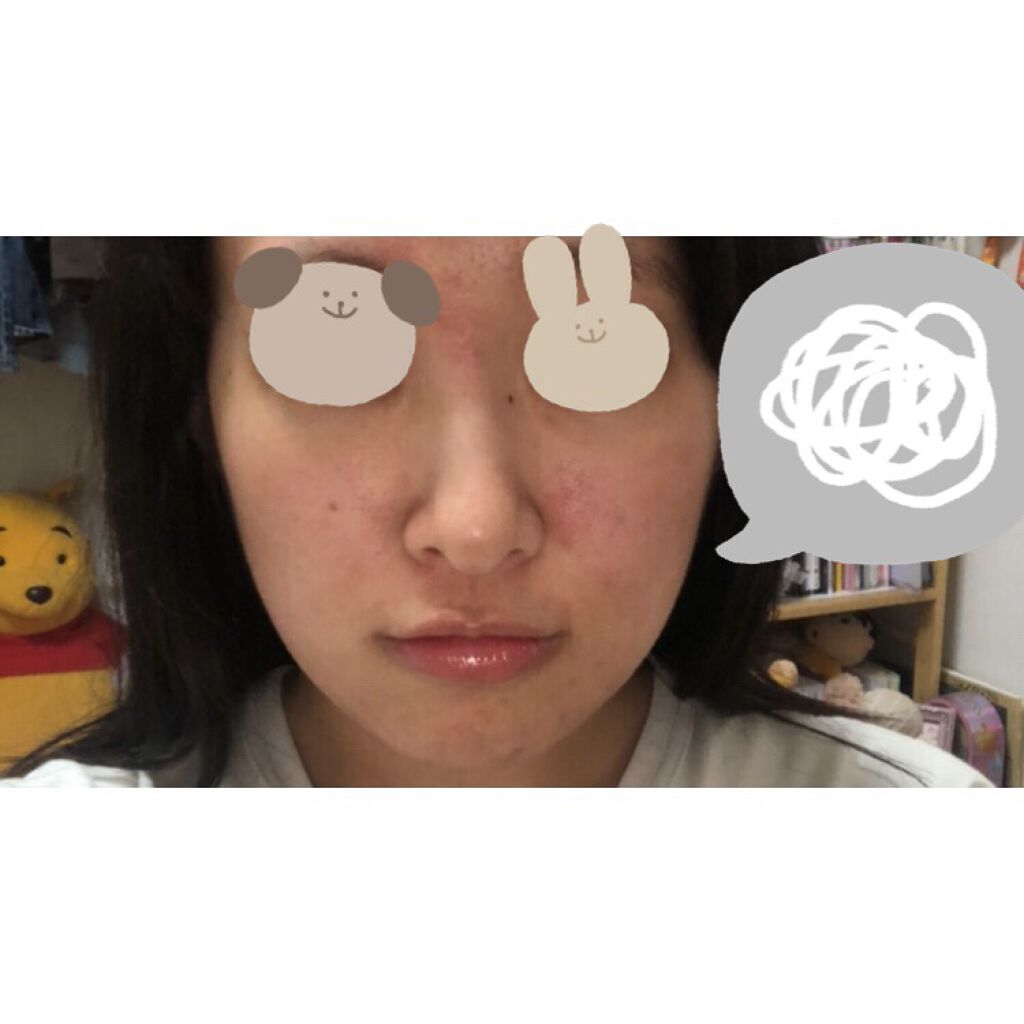 ミノン アミノモイスト 薬用アクネケア ミルク/ミノン/乳液を使ったクチコミ（2枚目）