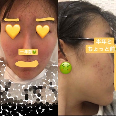 きなこもち on LIPS 「🤭どうしようもないなかった肌荒れをメイクしながら治した話🤭こん..」（2枚目）