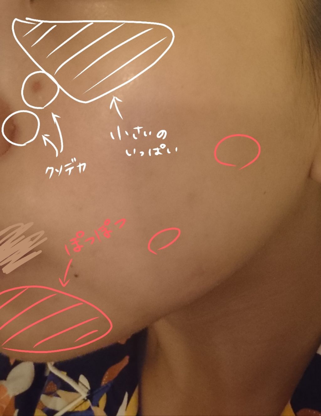 しお味 on LIPS 「※肌写真注意前回に引き続き、ニキビ絶対殺す月間継続中です。はじ..」(3枚目)