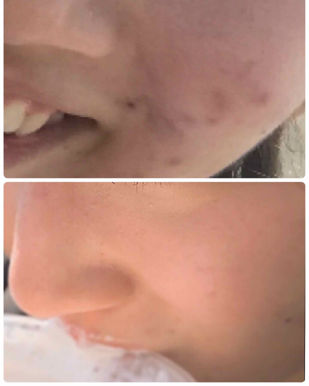 ニキビあとケアジェル/アットノン/その他スキンケアを使ったクチコミ(4枚目)
