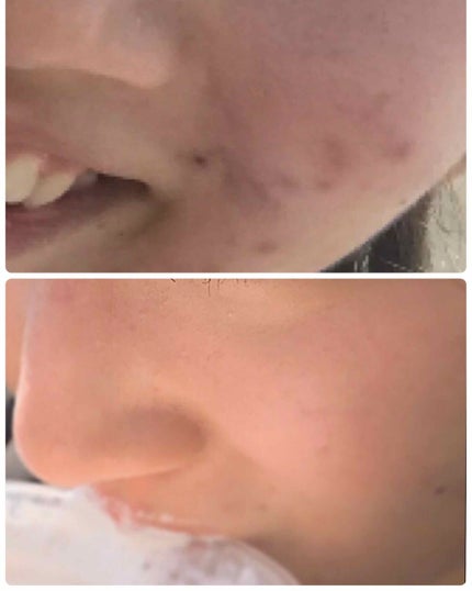 ニキビあとケアジェル/アットノン/その他スキンケアを使ったクチコミ(4枚目)