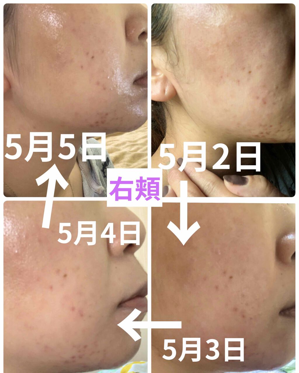 Hika1* on LIPS 「エピデュオ経過報告‼️⚠️汚肌写真注意5月1日からエピデュオゲ..」(3枚目)