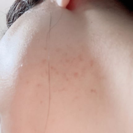 AHA 30% + BHA 2% Peeling Solution/The Ordinary/ピーリングを使ったクチコミ(5枚目)