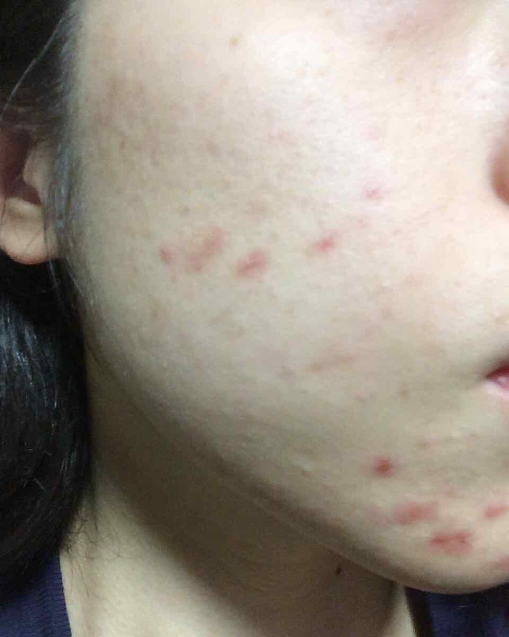 薬用 しみ 集中対策 美容液/メラノCC/美容液を使ったクチコミ(2枚目)