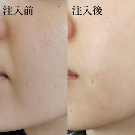 ã¯ãªð«§ on LIPS ããã»ãããç·ãã¢ã«ãã³é
žã¬ããïŒæäžæ¬ã«ã»ãããç·ã«ãã¢ã«ãã³..ãïŒ6æç®ïŒ