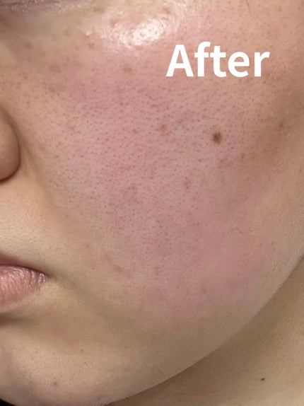 ヘパトリート 薬用保湿ミルククリーム/ゼトックスタイル/ボディクリームを使ったクチコミ(2枚目)