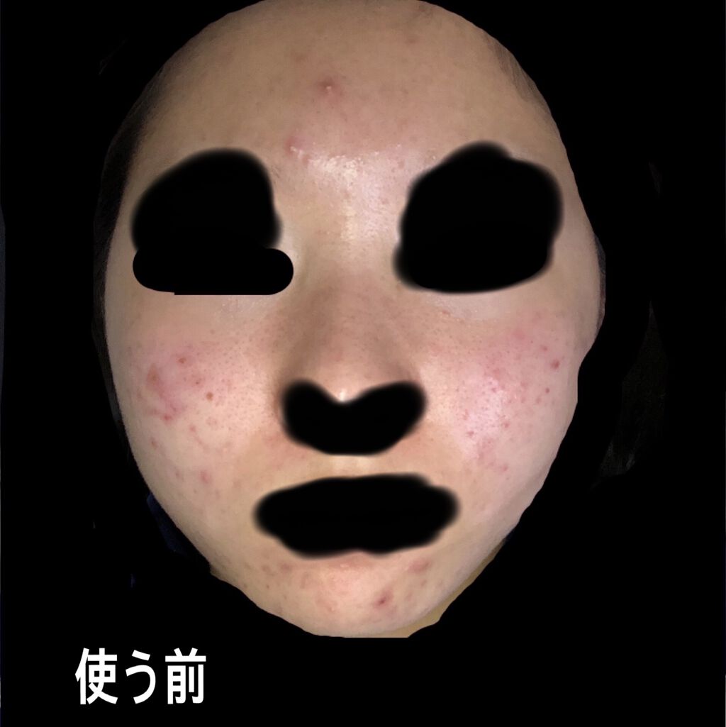 ティーツリーケアソリューション アンプルマスクJEX/MEDIHEAL/シートマスク・パックを使ったクチコミ（2枚目）