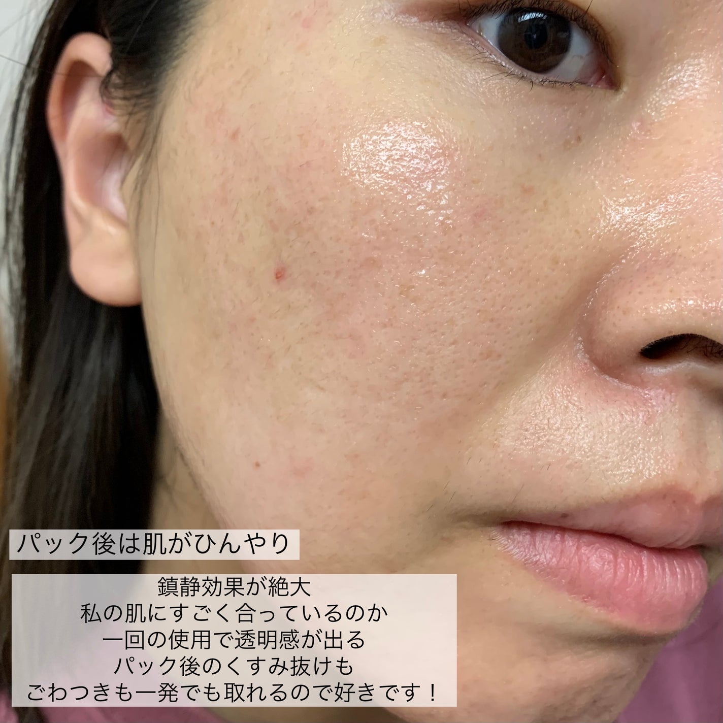 ドクダミ77 % 鎮静マスクパック/Anua/シートマスク・パックを使ったクチコミ(7枚目)