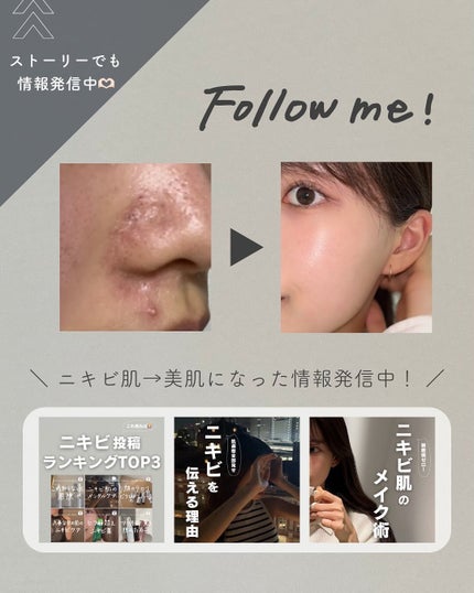 白湯(サユ) | ニキビと戦うOL🤍 on LIPS 「..よく質問もらう「ニキビ肌のパウダー」問題!テカリが気にな..」(8枚目)