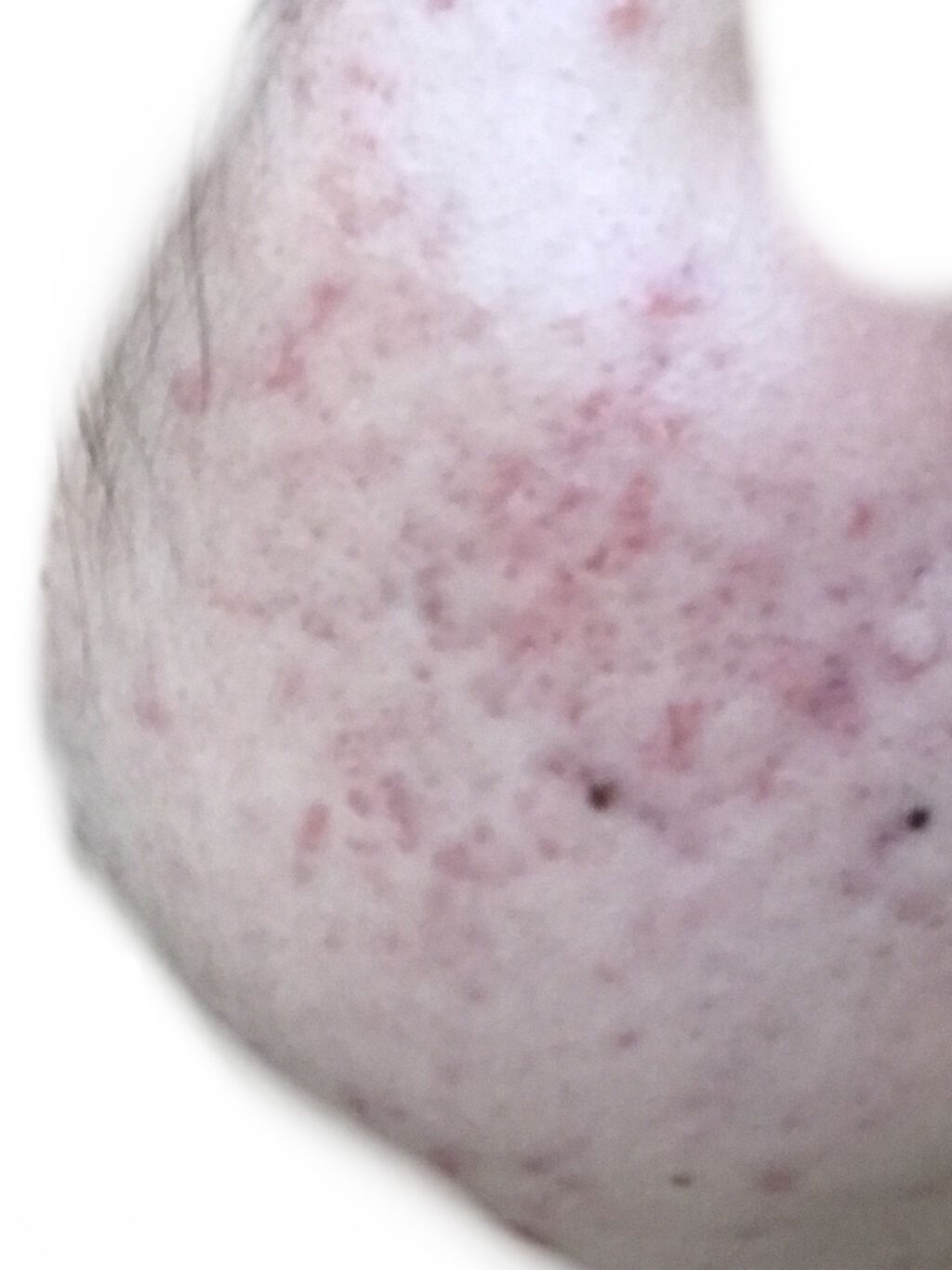 ニキビあとケアジェル/アットノン/その他スキンケアを使ったクチコミ（2枚目）